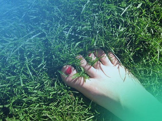 Test de Coleman y Maniobra de Silfverskiöld. Pie Cavo Doloroso