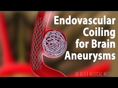 Endovascular Coiling for Brain Aneurysm, Animation.