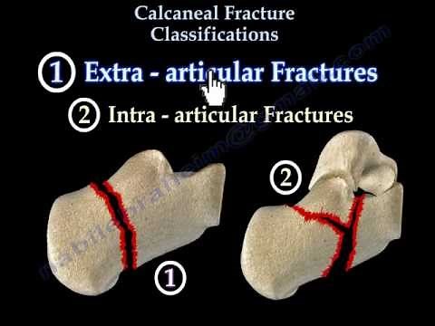 Calcaneal Fracture Classifications - Everything You Need To Know - Dr. Nabil Ebraheim