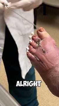 Simple pin removal from patients toes! Watch what happens!
