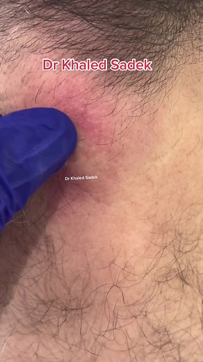 Infected neck cyst #cystremoval #drkhaledsadek #SkinCare