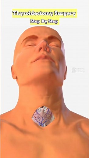 Thyroid Removal Surgery | Complete Step-by-Step 3D Guide