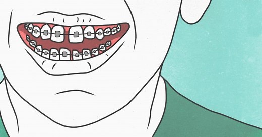 Do you need a permanent metal retainer after you’ve had braces?