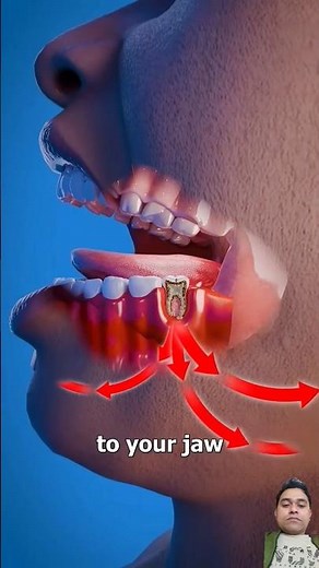 Tooth Abscess Explained What Happens & How to Treat It | Education Films