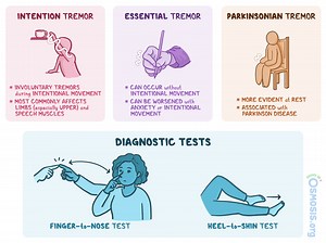 Intention Tremor: What Is It, Causes, Diagnosis, Treatment, and More | Osmosis