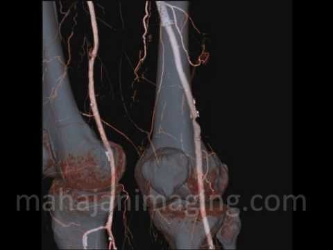 Lower Limb CT Angiography