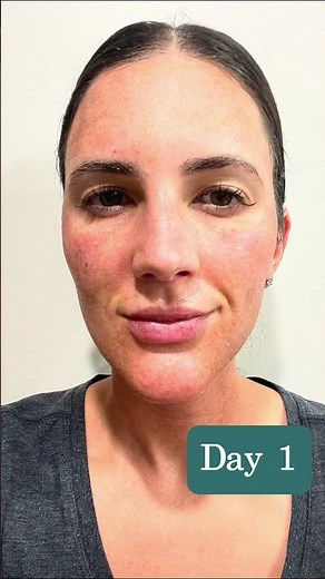 Helix Laser Treatment Demonstration