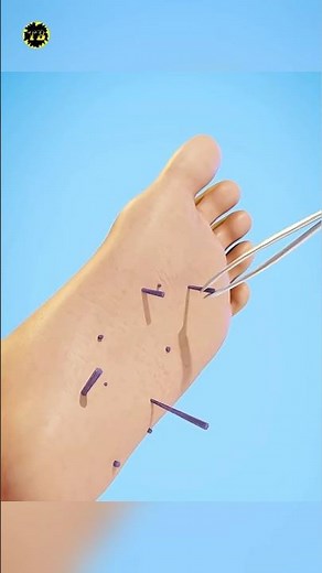 How splinters get unstuck [ You should see ] #facts #science