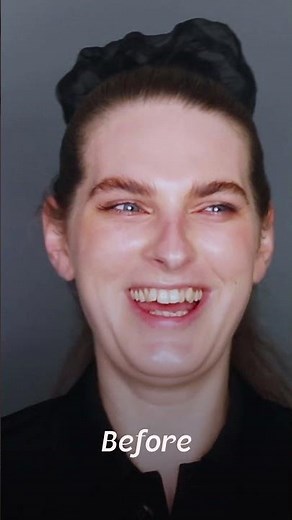 Jade, Australia — FFS Surgery Stories