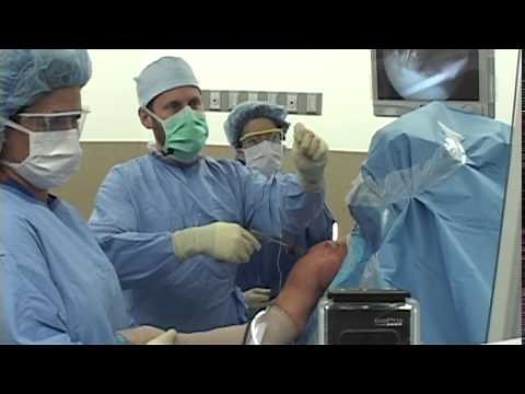 Dr. Frisella Arthroscopic Rotator Cuff Repair - Advanced Technique