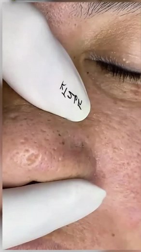 pimplepoppersatisfying su TikTok