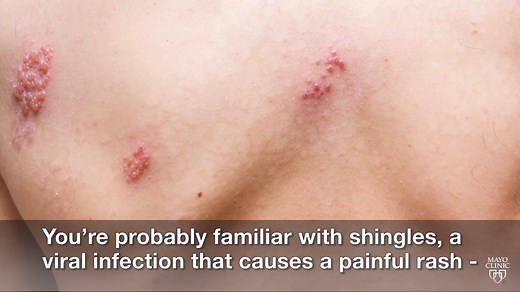 You're probably familiar with shingles, a viral infection that causes a painful rash — usually on the body's torso. But did you know that shingles also can affect the eye? Hear from Dr. Keith Baratz, an ophthalmologist, in this Mayo Clinic Minute. https://mayocl.in/2IAD0FJ | Mayo Clinic