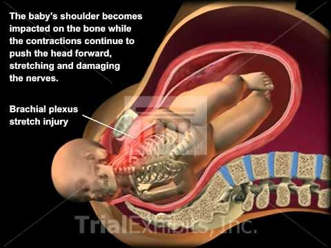 Shoulder Dystocia Medical Animation