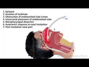 Complications of Nasal Endotracheal Intubation