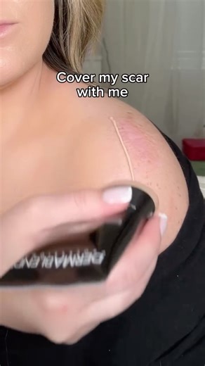 Ally Lindgren 🍋 on Instagram: "After skin cancer and multiple biopsies, my shoulders have become an insecurity of mine. I love this @dermablendpro body makeup bc it has high-pigment coverage, additional SPF protection that I need, and a formula that’s dermatologist-tested, fragrance-free, non-comedogenic, and safe for sensitive skin like mine. It gives me the confidence to show my shoulders again without worrying about irritation or fading. When I was a bridal makeup artist, Dermablend was my g