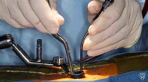 Advances in minimally invasive spine surgery - Mayo Clinic
