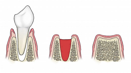 How Long Does it Take the Hole to Close after a Tooth Extraction