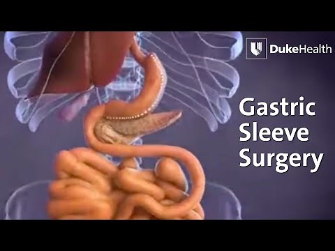 Gastric Sleeve Surgery | Duke Health