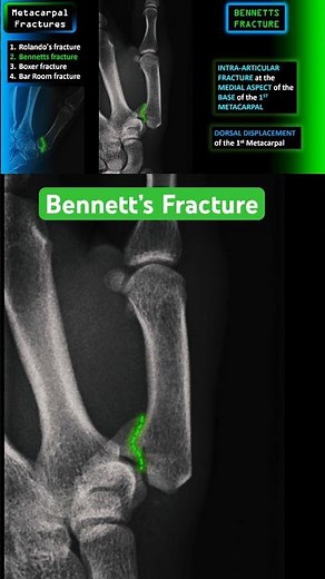 Thumb Fracture - Bennett’s fracture #shorts #radiology #xray #trauma