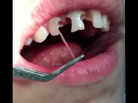 Tooth Nerve Removal