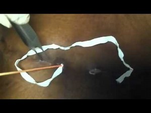 Surgical Packing post abscess drainage - www.lasermemphis.com