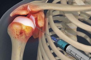 Shoulder Injection: Corticosteroid, Viscosupplementation