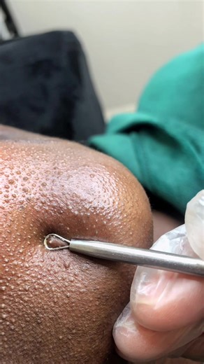 EXTRACTION COMEDONS #peaugrasse#soinprofondvisage #extractionsatisfaciton #comedons #extractionsfacial #sébum #excèssebum #nettoyageenprofondeur #soinvisageparis #soinvisage94 #asmr #videosatisfaisante #viral #