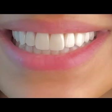 ღ your teeth are literally perfect! ~ veneers procedure 💉