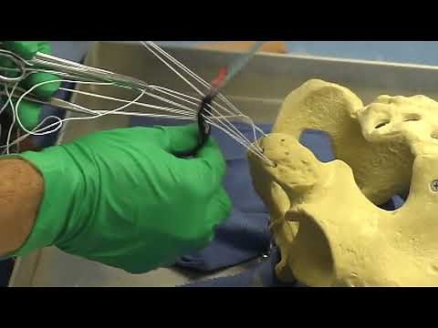 Reconstruction of Chronic Proximal Hamstring Tear: Description of a Surgical Technique