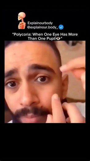 Explainourbody on Instagram: "Polycoria: When One Eye Has More Than One Pupil It looks unusual, but it’s a rare medical condition. What’s happening? • Polycoria occurs when the iris develops multiple openings (pupils) instead of one • True polycoria is extremely rare — some cases are called pseudo-polycoria when extra openings don’t fully function as pupils • Can affect light entry and vision clarity • Often diagnosed during an eye exam, sometimes requiring specialized imaging Fun facts: • Some 
