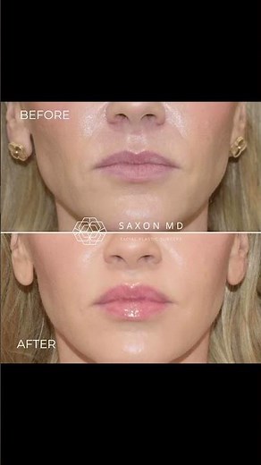Lip Lift Before and After | Dr. Sarah Saxon