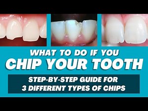What to Do If You Chip Your Tooth | Step-by-Step Guide for 3 Different Types of Chips