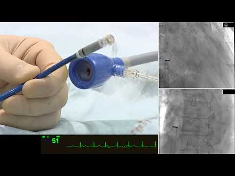 リードレス・ペースメーカー植え込み術（Leadless pacemaker implantation: Micra)