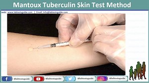 Mantoux Tuberculin Skin Test Purpose, Procedure, Result and more