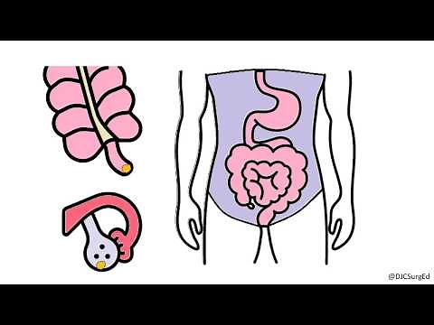 Pseudomyxoma Peritonei