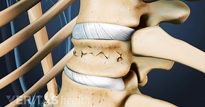 Types of Spinal Compression Fractures