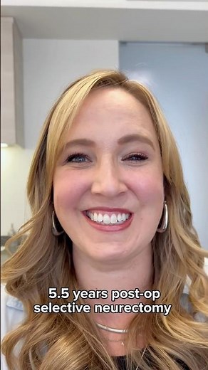 5.5 year post-op selective neurectomy #facialparalysis #plasticsurgery