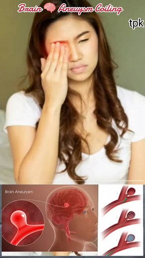 Brain Aneurysm Coiling Treatment: Understanding the Procedure