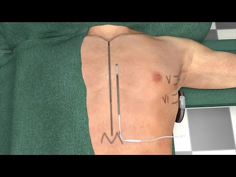 EMBLEM™ S-ICD: Intermuscular 2IT Technique Guide