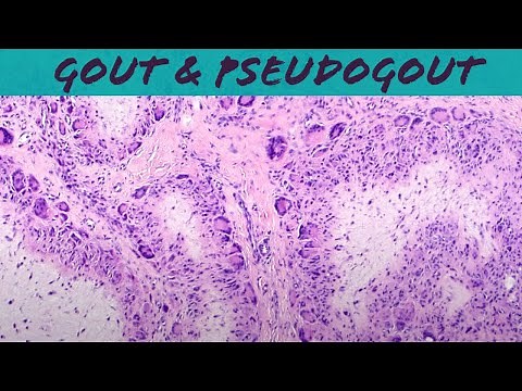 Gout & Pseudogout (calcium pyrophosphate deposition disease - chondrocalcinosis) pathology USMLE