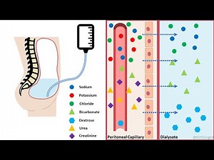 Peritoneal Dialysis