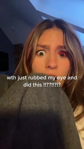 red eye explained | red eyes