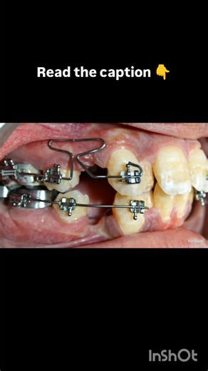 Dr Ananya Mukherjee on Instagram: "Magic of "T Loop" The T-loop is a versatile and widely used orthodontic wire configuration in space closure and tooth movement mechanics, especially in the segmented arch technique. Here's a detailed overview: What is a T-Loop? A T-loop is a loop made in an orthodontic archwire, resembling the letter "T". It provides controlled and efficient force systems for tooth movement. T-loops are commonly used for space closure, root control, and bodily tooth movement. D