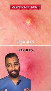 Dr Somji explains how to treat Acne| Mild, Moderate & Severe Acne