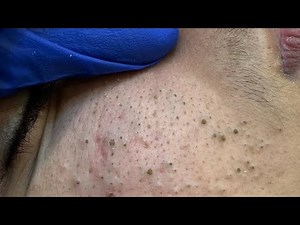 Deep Cleansing Techniques — Satisfying Pimple Extraction Methods