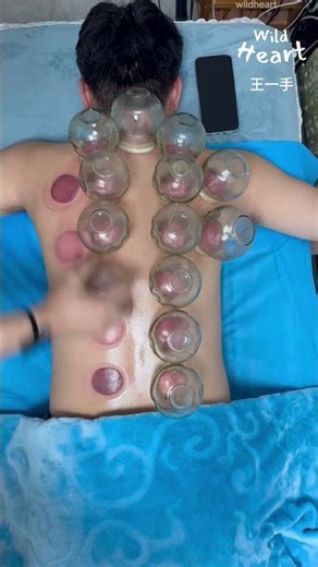 How Fire Cupping Works