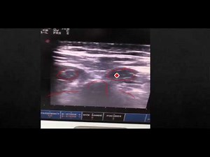 Paraspinal needle Electromyography testing procedure