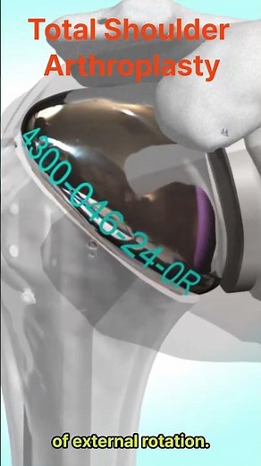 Total shoulder arthroplasty : Principle, Procedure and Results