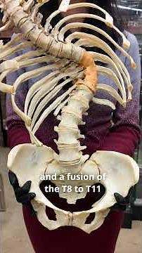 Scoliosis Explained: Different Types and Their Impacts