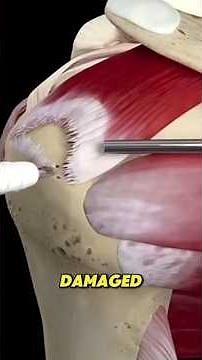 Rotator Cuff Repair Surgery (3D Animation) #medical3danimation